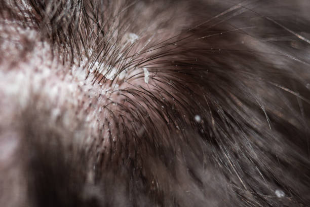 Dandruff home remedies 
