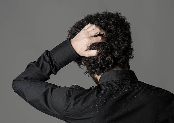 Dandruff home remedies 
