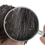 DANDRUFF HOME REMEDIES