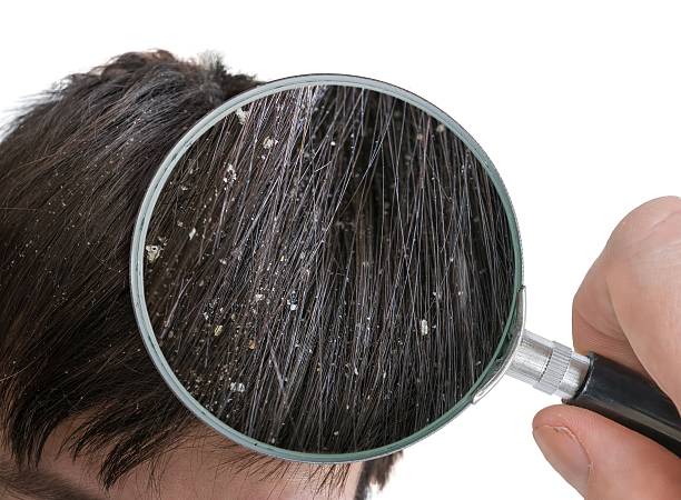 DANDRUFF HOME REMEDIES